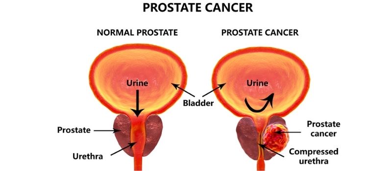 best prostate cancer treatment adenoma tünetei