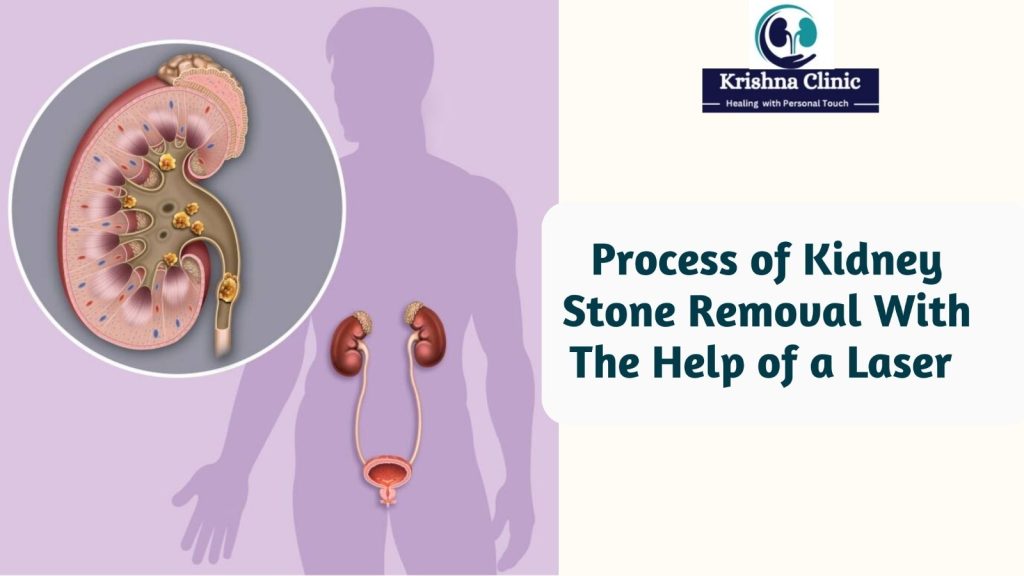 Process of Kidney Stone Removal With The Help of a Laser@KrishnaClinic