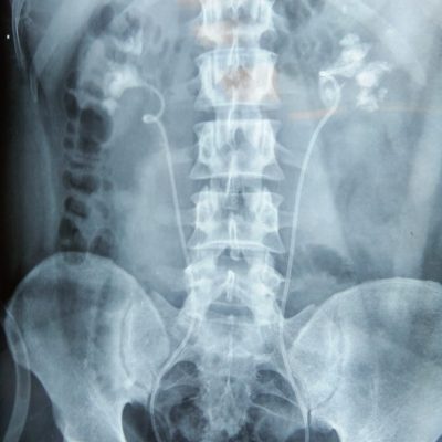 feed3 B/L RENAL Stone Patient (STAGHORN)