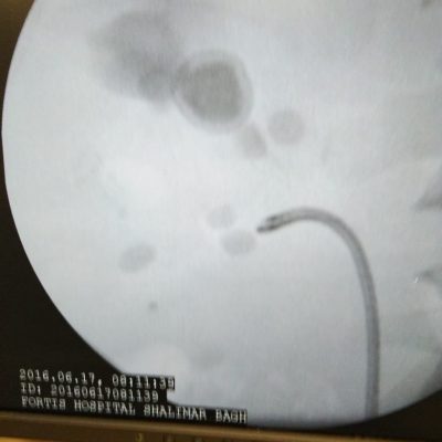 feed4 Stones In Almost All Calyces Of Kidney Managed By RIRS